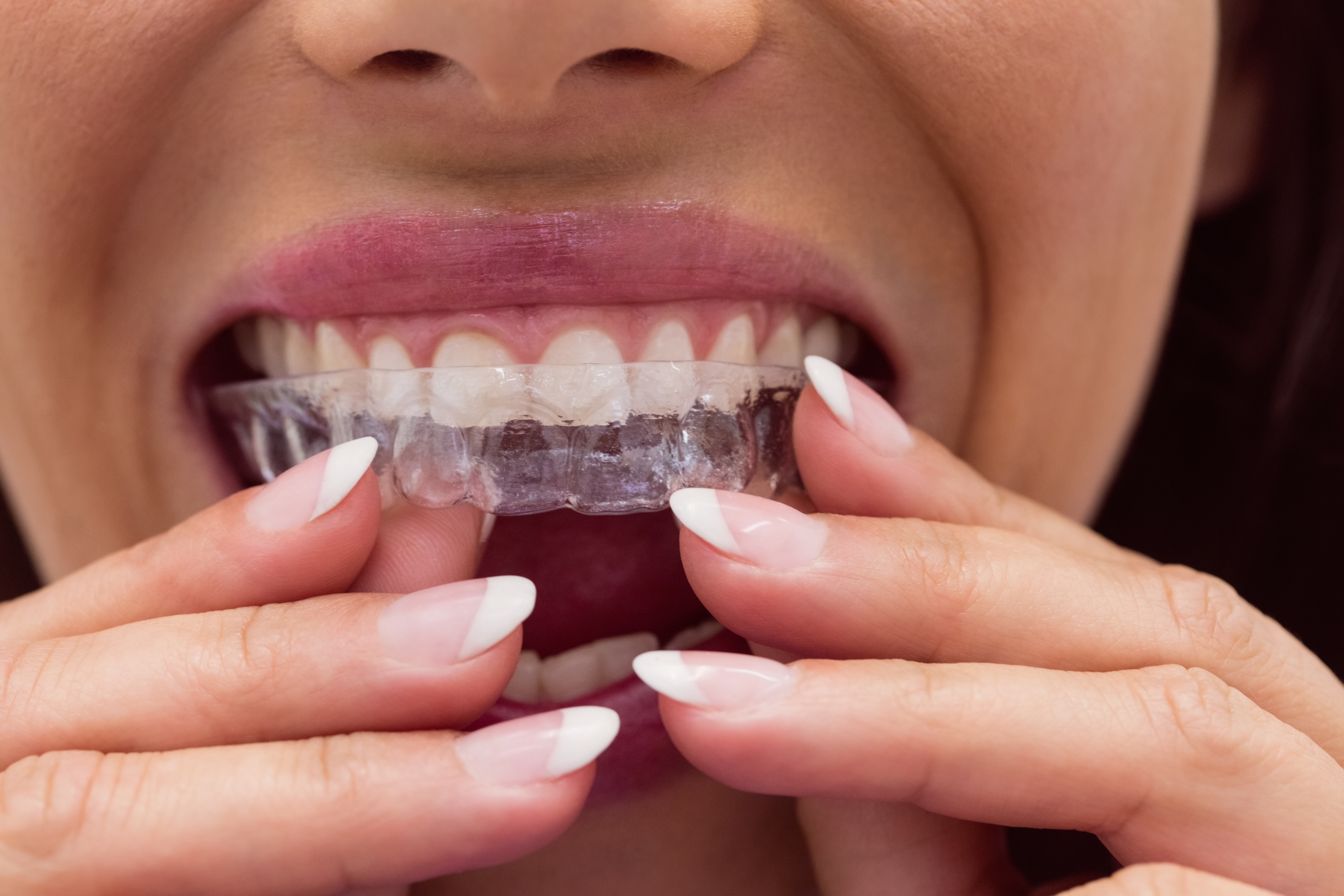 Invisibili ma potenti: come gli allineatori dentali hanno conquistato il mercato